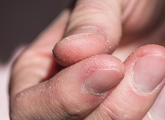 Kişinin parmaklarında kuru cilt görünümü görülüyor